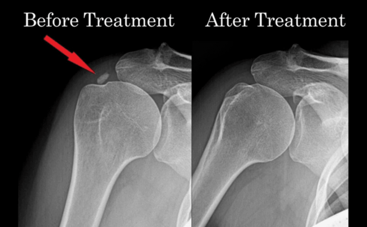 Calcific Tendonitis of the Rotator Cuff illustration