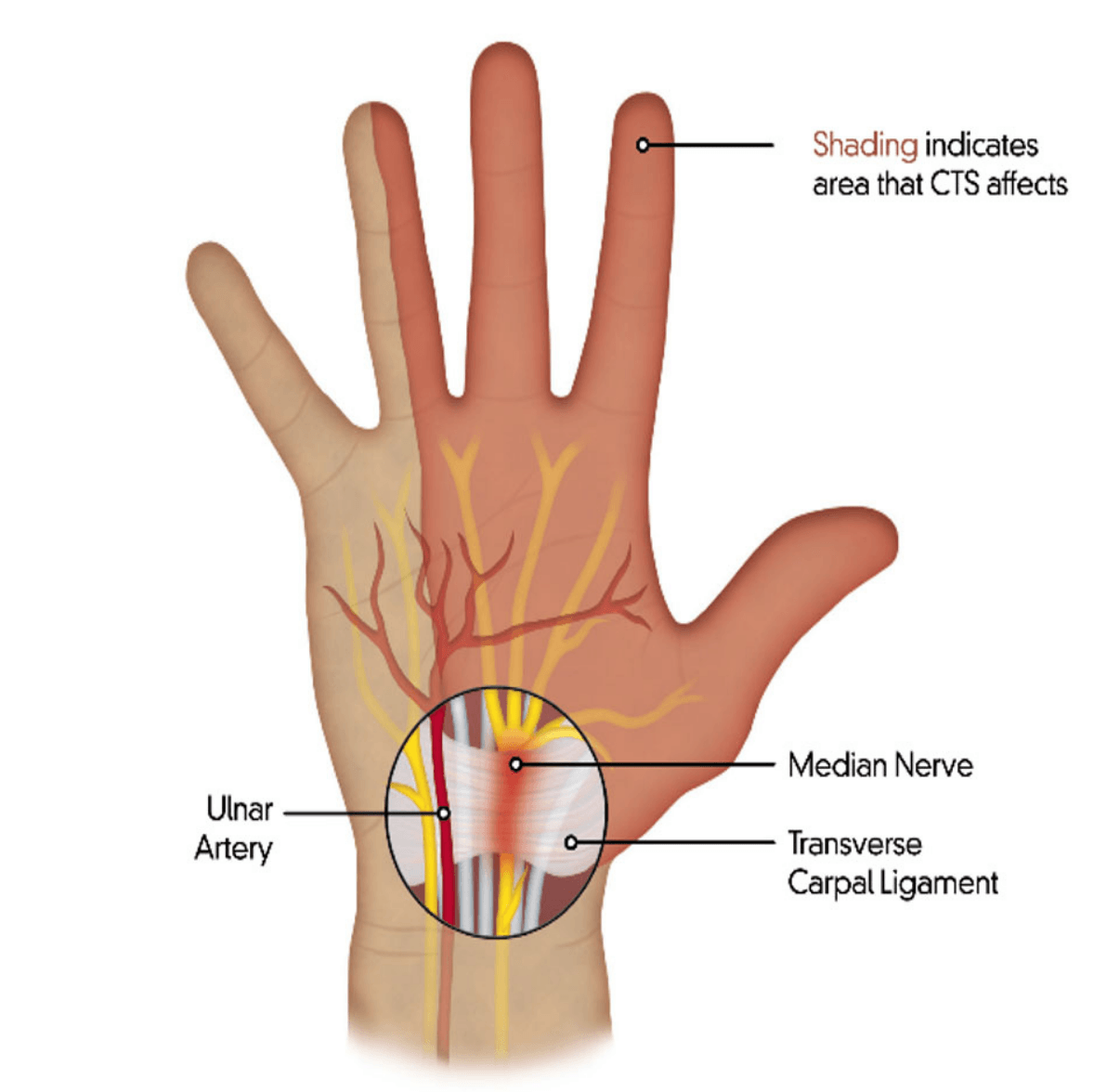 Carpal Tunnel Syndrome illustration
