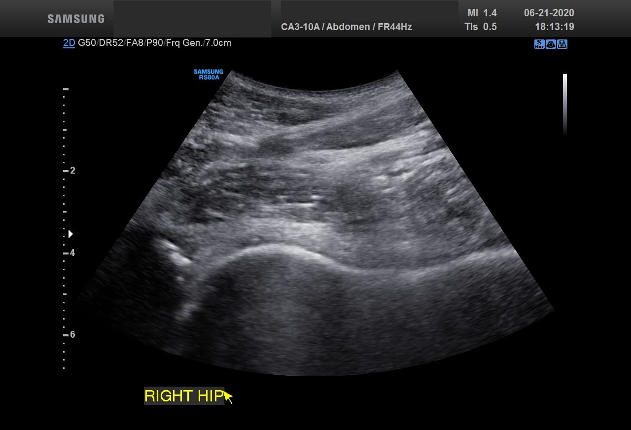 Diagnostic musculoskeletal ultrasound image of a hip