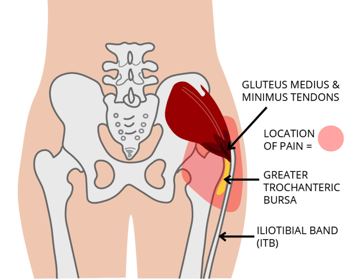 Gluteal Tendinopathy illustration