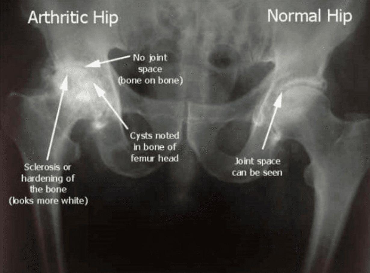 Hip Arthritis illustration