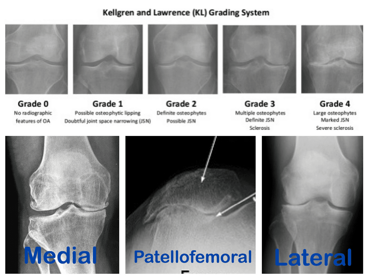 Knee Arthritis illustration
