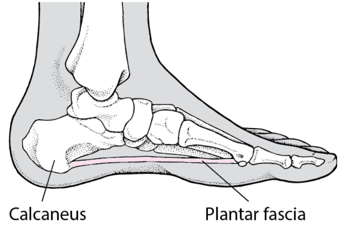 Plantar Fasciopathy (Plantar Fasciitis) illustration
