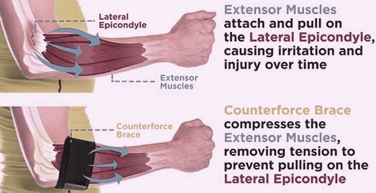 Tennis Elbow (Lateral Epicondylitis) illustration