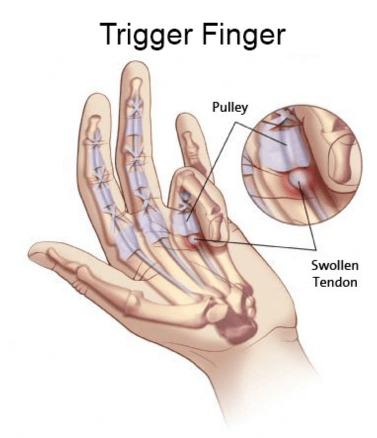 Trigger Finger illustration
